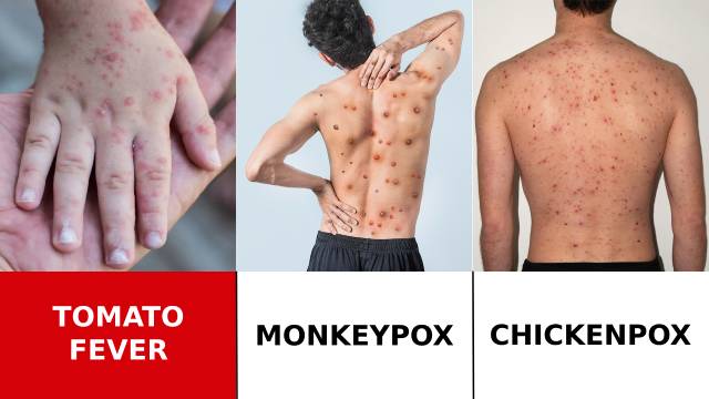 Tomato Fever, Monkeypox and Chickenpox – What is Tomato Fever? What are its symptoms and preventions?