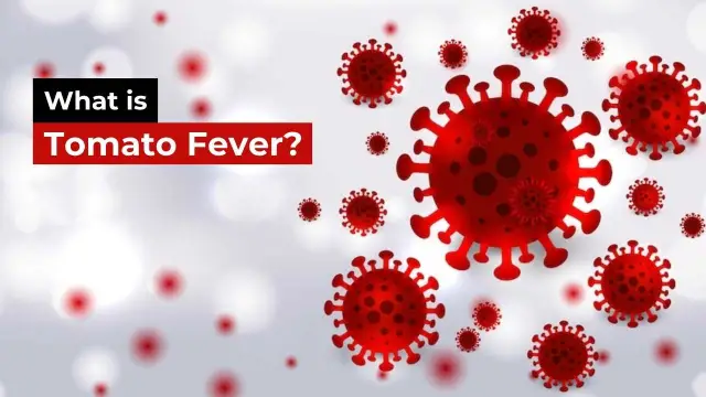 What is Tomato Fever? What are its symptoms and preventions?
