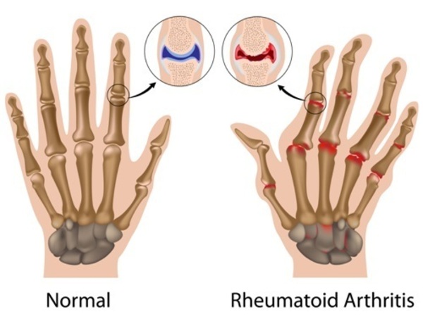 People with rheumatoid arthritis