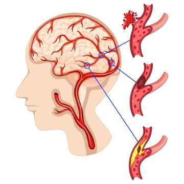 Infections in the brain